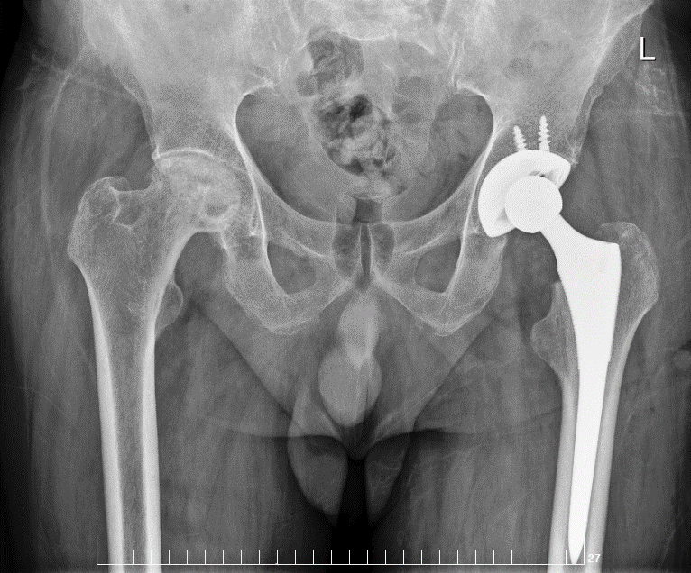 Post-op Hip Arthroplasty: Blood Transfusion Reaction