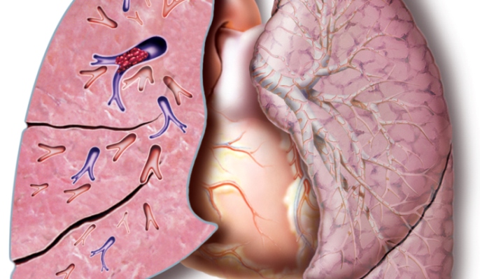 Post-op Hemicolectomy: Pulmonary Embolism