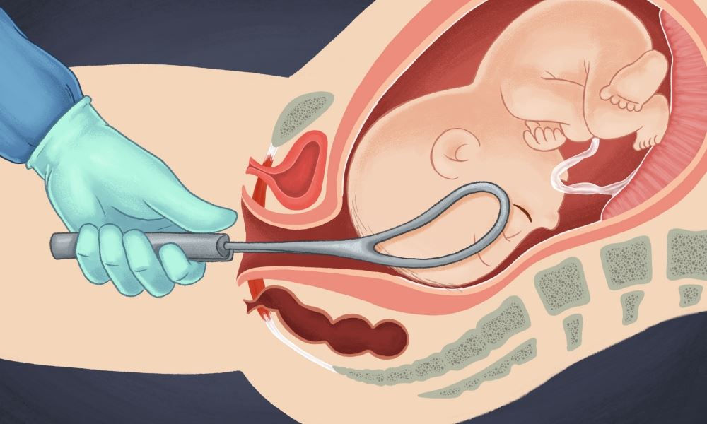 An Instrumental Vaginal Delivery - Anterior