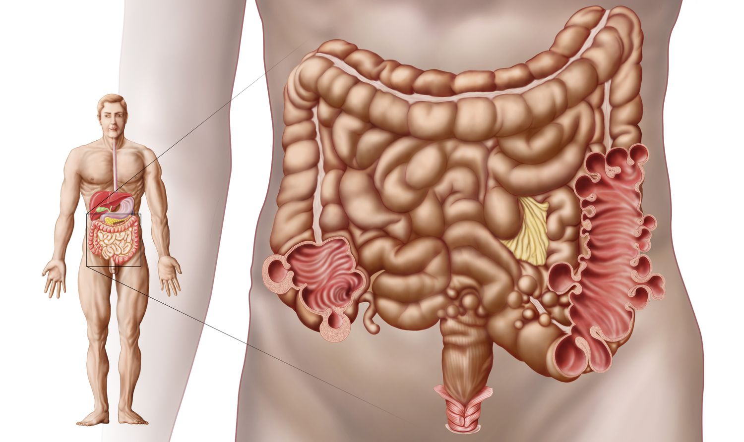 Postoperative Care of the Patient with a Ruptured Diverticulum