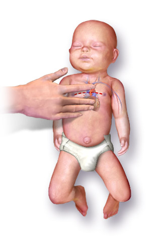 Infant Cardiopulmonary Failure