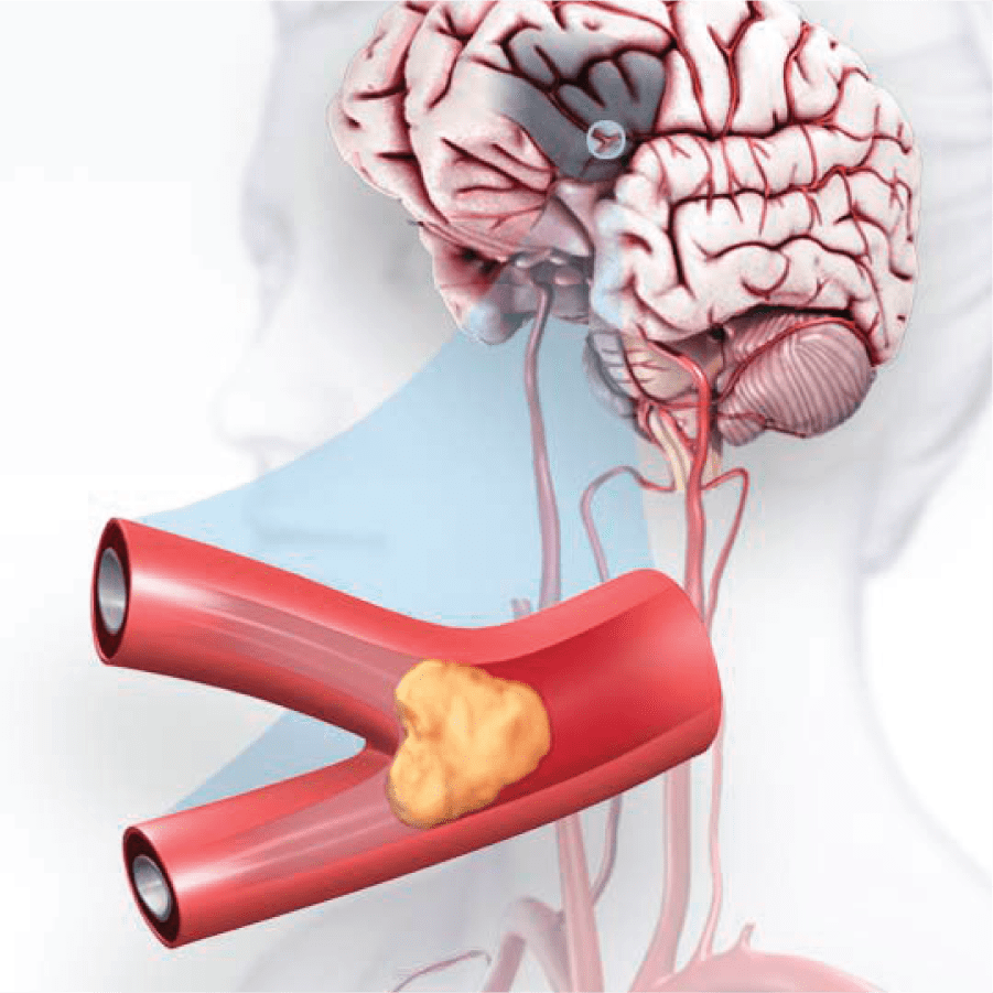 Acute Ischemic Stroke