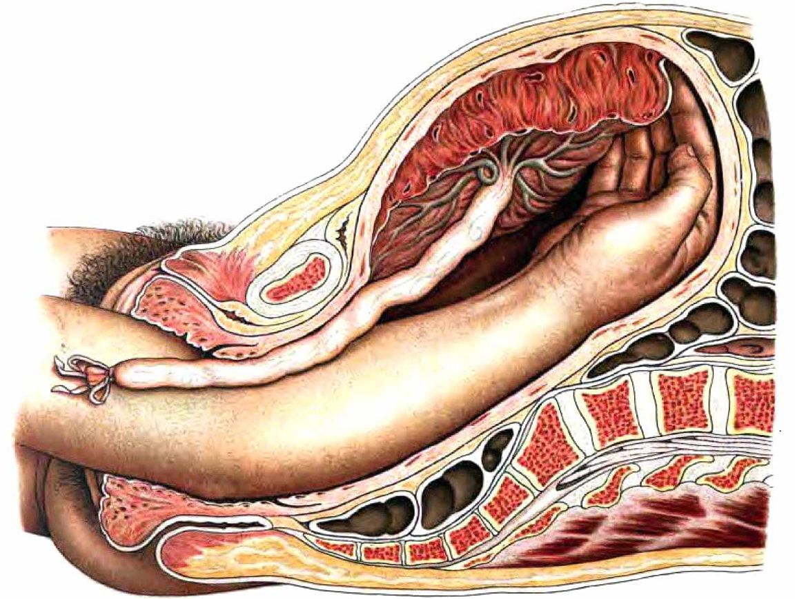 Moderate Postpartum Hemorrhage