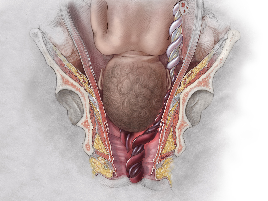 Umbilical Cord Prolapse