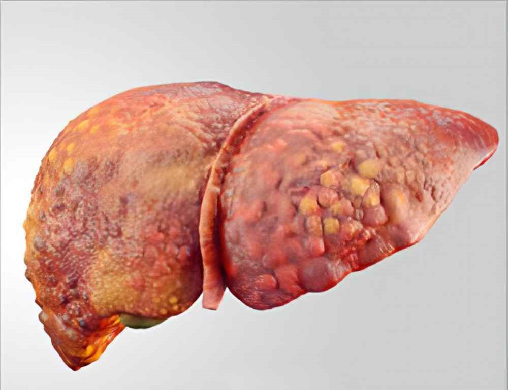 Hepatic Cirrhosis