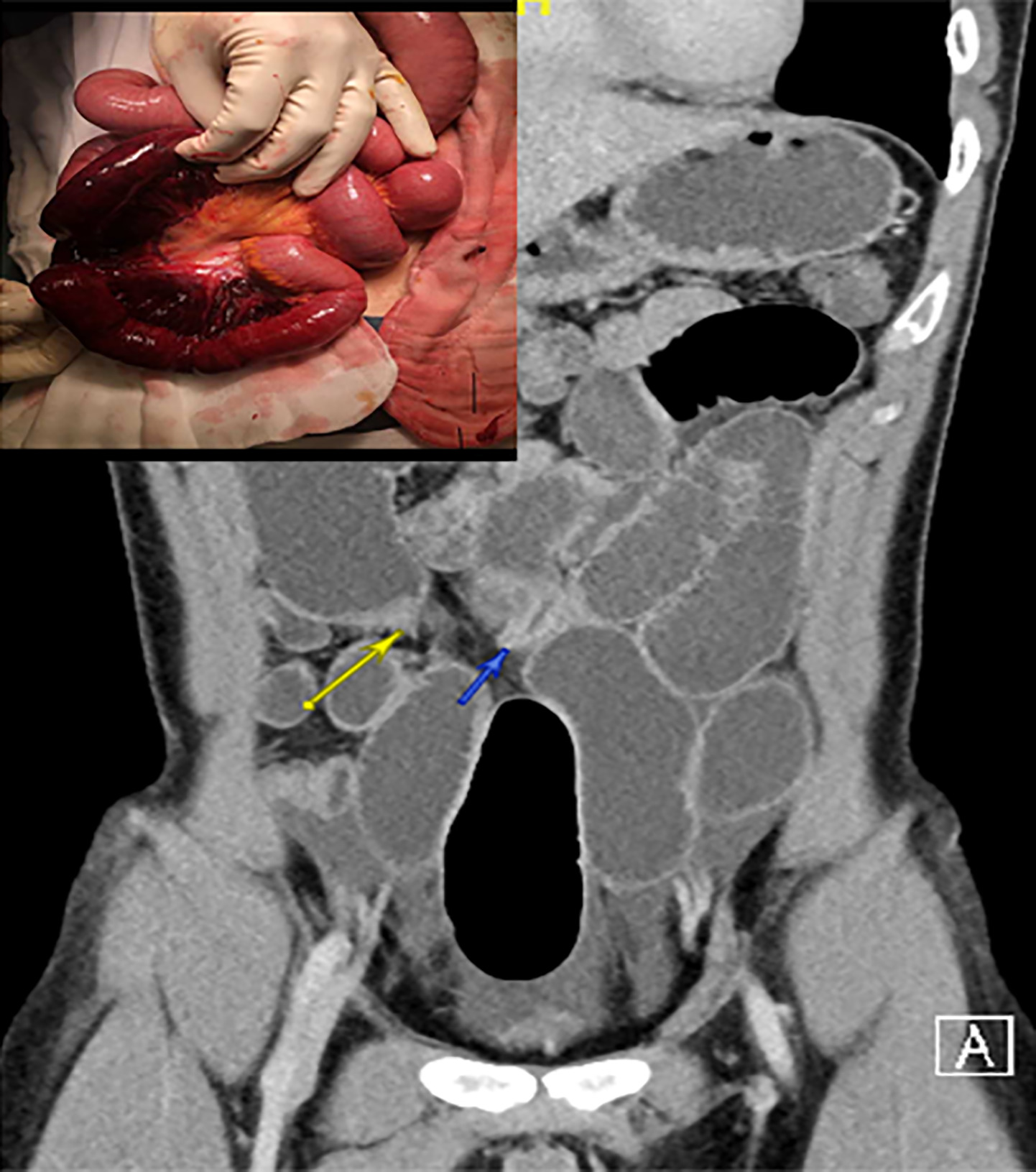 Preoperative Bowel Obstruction: Fluid and Electrolyte Imbalance