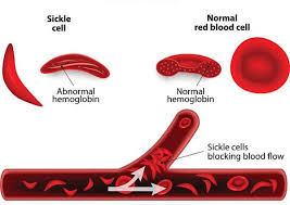 Sickle Cell Anemia with Acute Pain Crisis