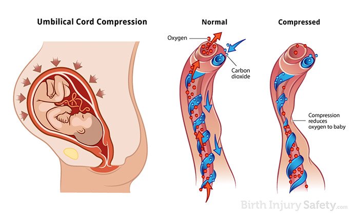 Preparation for C-Section due to Umbilical Cord Prolapse