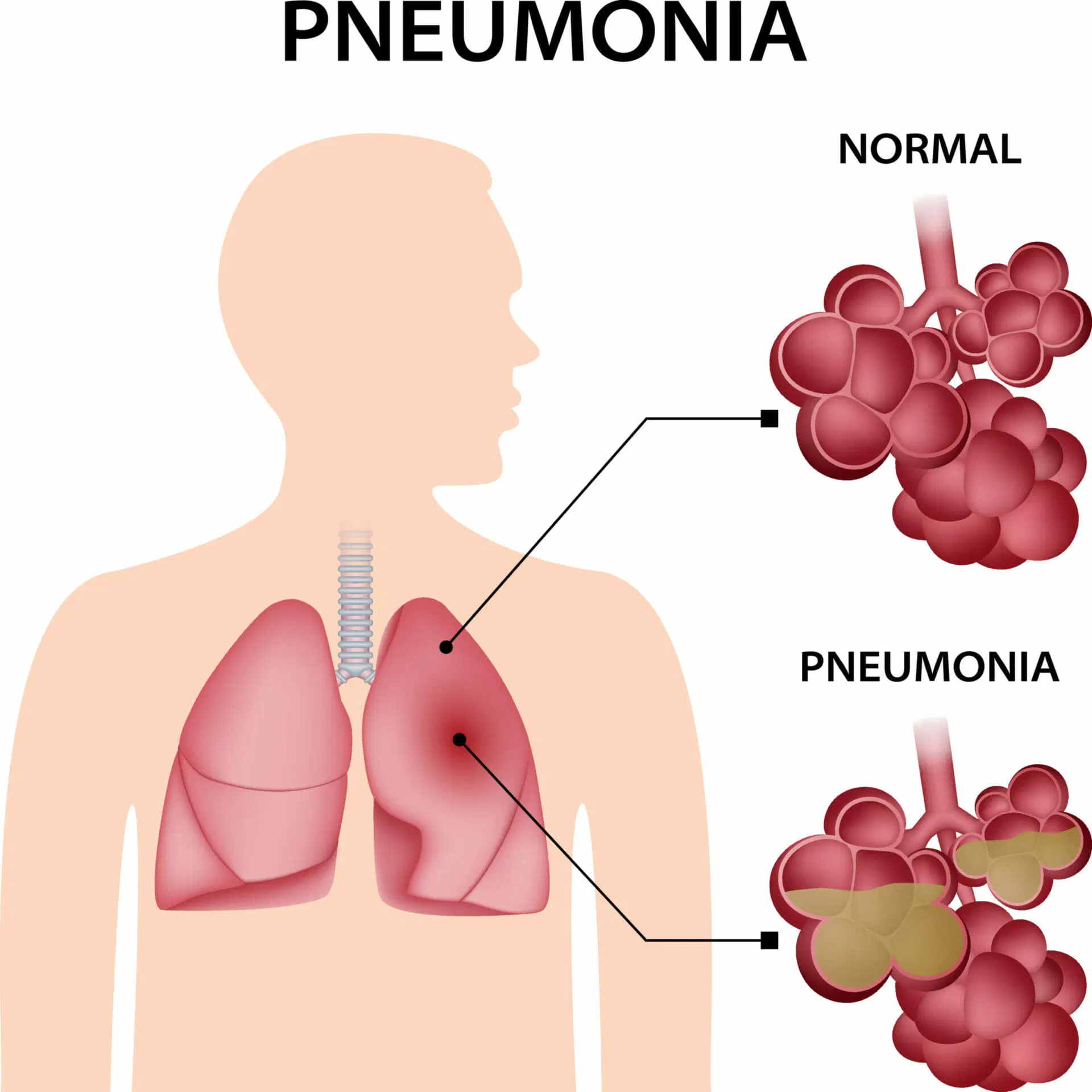 Pneumonia: Severe Reaction to Antibiotic