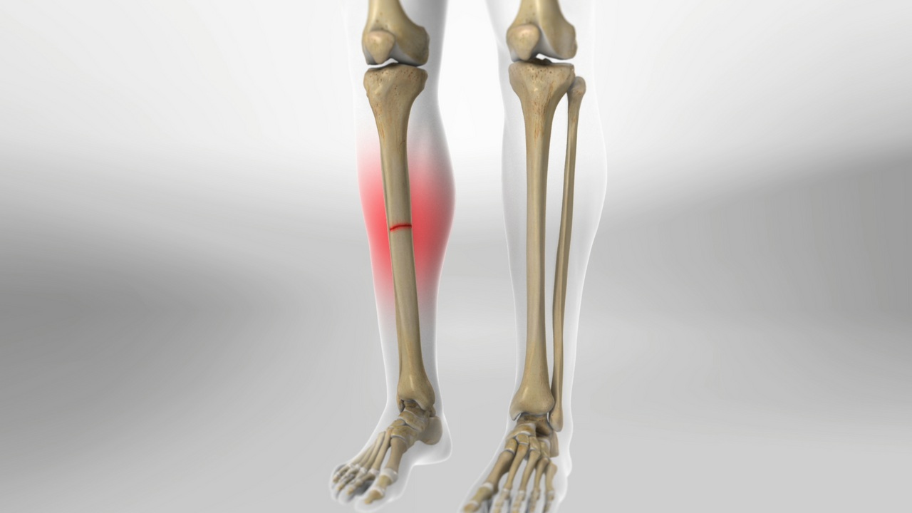 Lower Leg Fracture: Compartment Syndrome