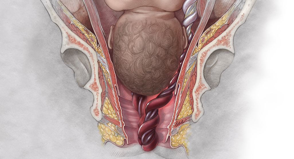 Umbilical Cord Prolapse