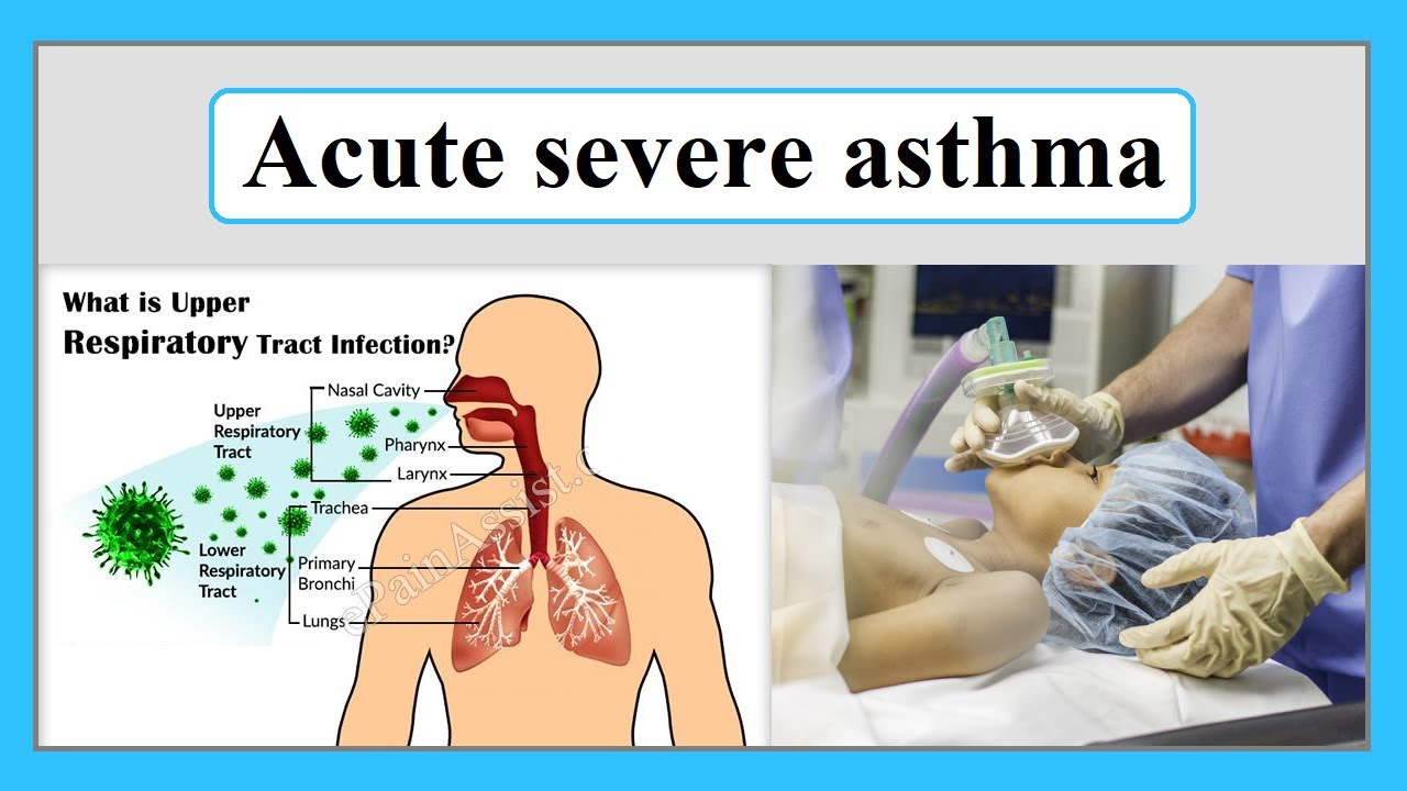 Acute Severe Asthma