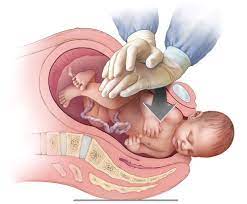 Delivery with Risk of Shoulder Dystocia