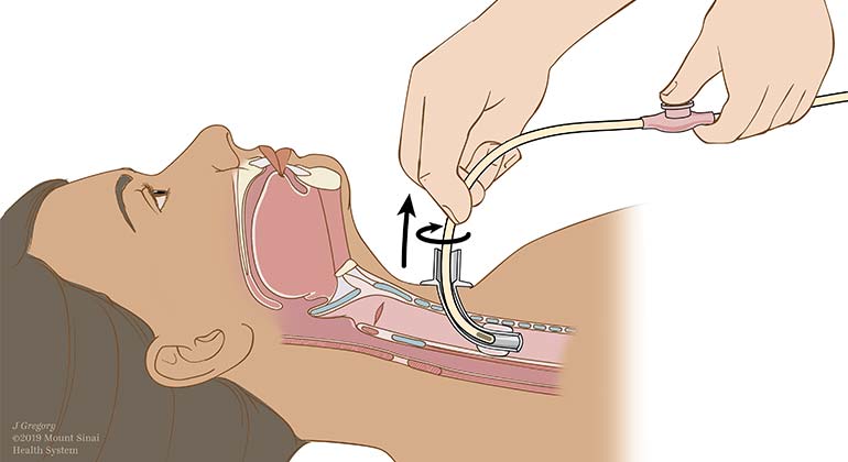 Suctioning and Tracheostomy Care with Hypoxia