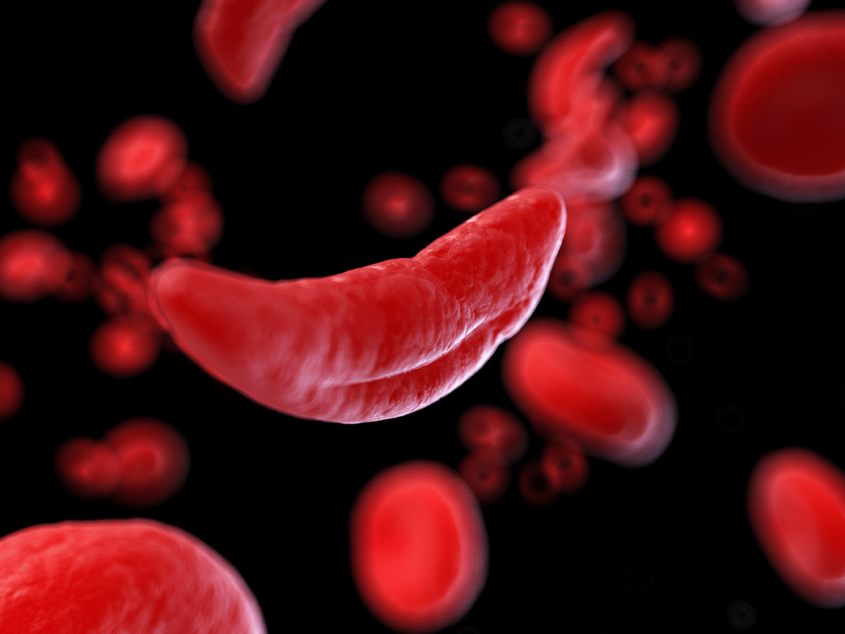 Sickle Cell Crisis