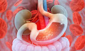 Gastrointestinal Bleed Secondary to Esophageal Varices