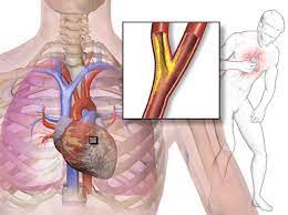 Management of Nitroglycerin Administration for the Treatment of Angina Pectoris