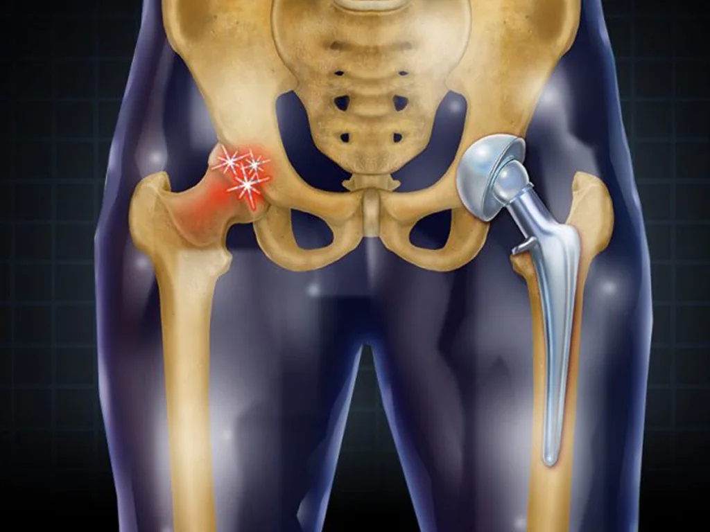 Basic Assessment of the Hip Replacement Patient